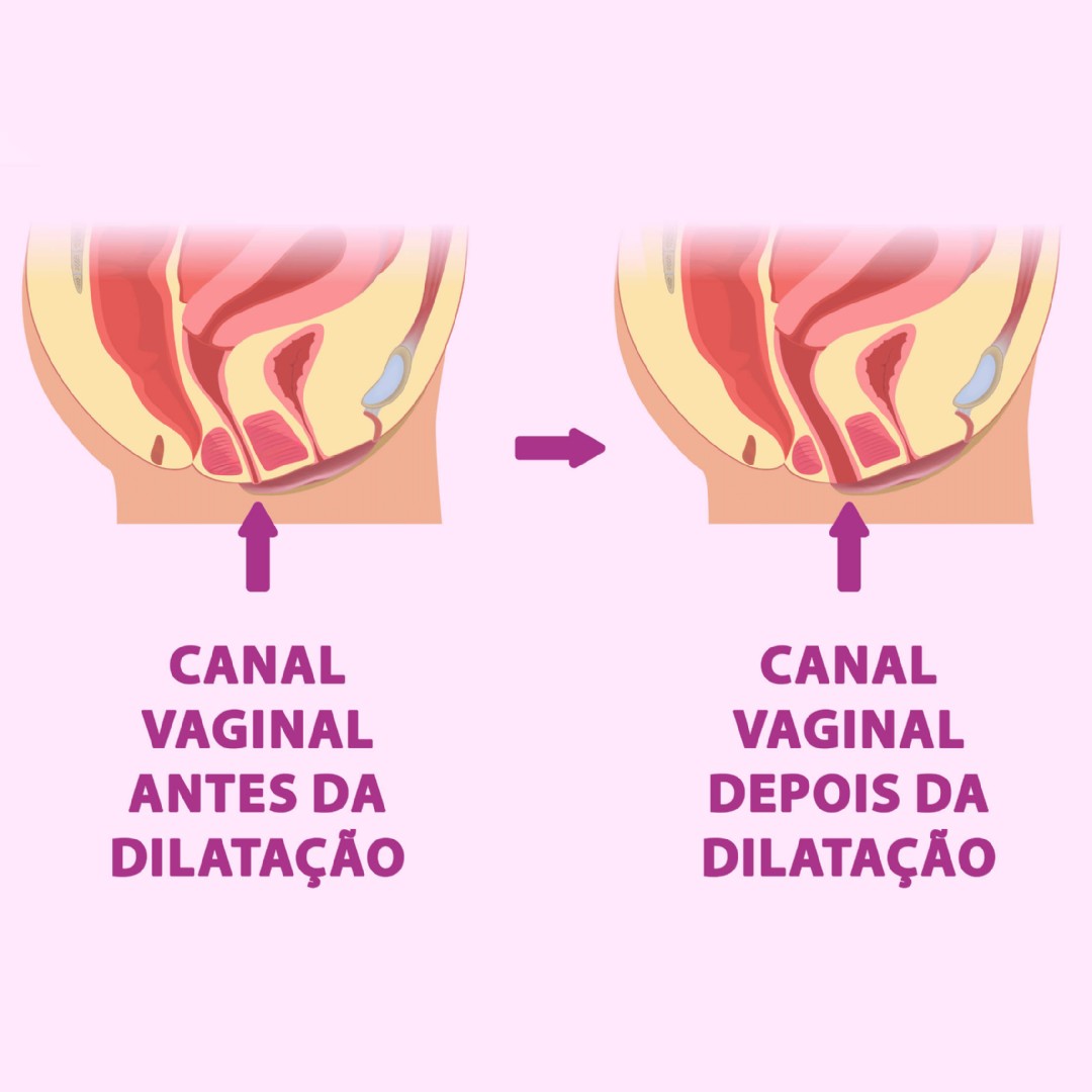 Ilustra��o de um canal vaginal antes e depois da dilata��o, mostrando o relaxamento da musculatura